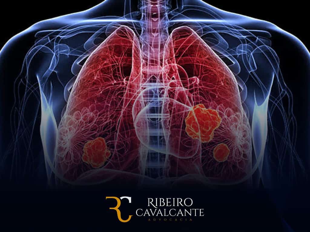 Pneumoconioses: Auxílio-doença e aposentadoria por invalidez em 2024