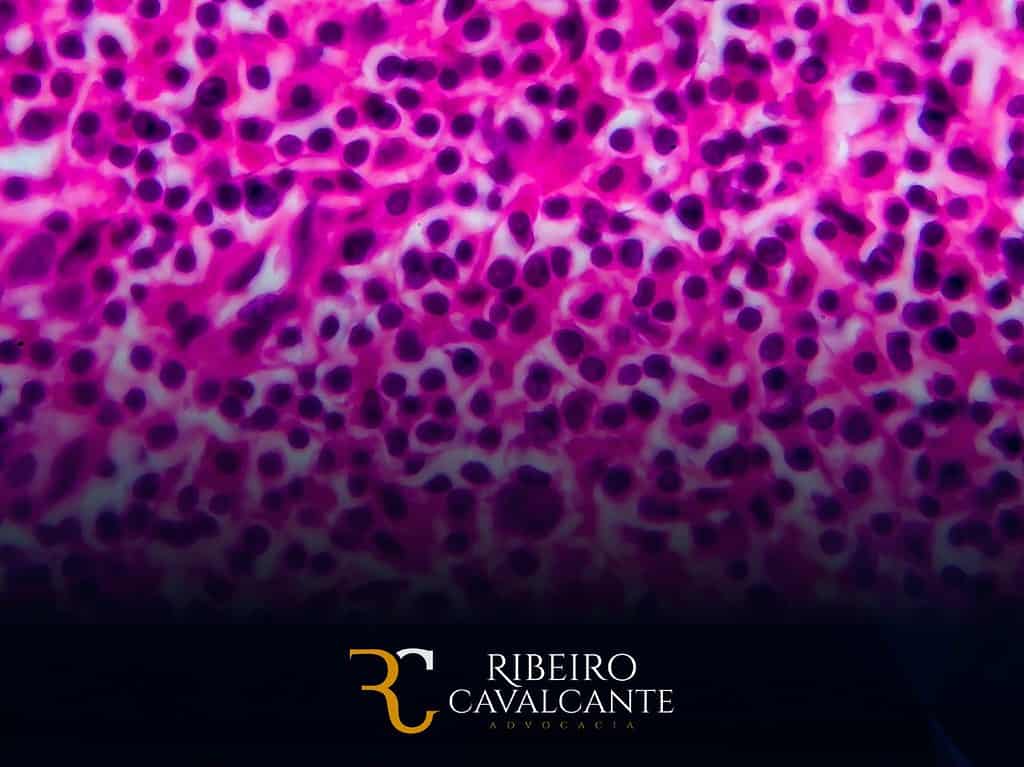 Linfoma de Hodgkin e o Benefício de Prestação Continuada (BPC-LOAS) em 2024