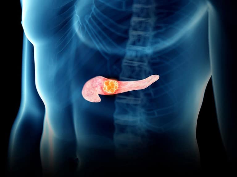 Radiografia do tronco humano mostrando câncer de pâncreas em destaque. Ilustração médica do sistema digestivo.