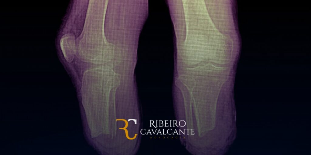 Amputações múltiplas, auxílio-doença, aposentadoria por invalidez, Ribeiro Cavalcante Advocacia