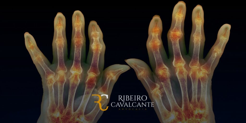A artrite reumatoide (AR) é uma doença autoimune crônica que causa inflamação nas articulações. A doença pode afetar qualquer articulação do corpo, mas é mais comum nos pulsos, mãos, pés e joelhos. O que é artrite reumatoide grave? A artrite reumatoide é considerada grave quando causa danos significativos nas articulações e interfere na capacidade do paciente de realizar atividades cotidianas. A doença pode causar deformidades nas articulações, perda de função e dor crônica. Exemplos de incapacidade causada pela artrite reumatoide grave A artrite reumatoide grave pode causar uma série de incapacidades que podem prejudicar a capacidade de trabalho do paciente. Alguns exemplos de incapacidade causada pela artrite reumatoide grave incluem: Dificuldade de locomoção: a dor e a deformidade nas articulações podem dificultar a capacidade do paciente de andar, correr ou subir escadas. Dificuldade de realizar tarefas cotidianas: a dor e a fadiga podem dificultar a capacidade do paciente de se vestir, se alimentar e realizar tarefas domésticas. Dificuldade de realizar atividades profissionais: a dor, a fadiga e a deformidade nas articulações podem dificultar a capacidade do paciente de realizar as atividades exigidas pelo seu trabalho. Exames necessários para solicitação de auxílio-doença e aposentadoria por invalidez Para solicitar auxílio-doença ou aposentadoria por invalidez por artrite reumatoide grave, o paciente deve apresentar os seguintes exames: Exame clínico: o médico irá avaliar o paciente e documentar seus sintomas. Exame laboratorial: o paciente pode ser submetido a exames laboratoriais para avaliar a inflamação, a função renal e a presença de anemia. Exames de imagem: o paciente pode ser submetido a exames de imagem, como raios-X, tomografia computadorizada ou ressonância magnética, para avaliar a extensão dos danos nas articulações e a presença de complicações. Laudo médico: o médico deverá atestar a incapacidade do paciente para o trabalho. Conclusão Se você é portador de artrite reumatoide grave e está incapacitado para o trabalho, você pode ter direito ao auxílio-doença ou aposentadoria por invalidez. A Ribeiro Cavalcante Advocacia pode ajudá-lo a solicitar os benefícios.