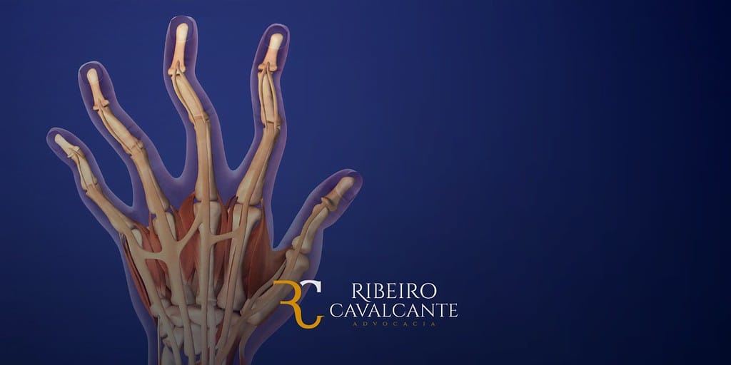 A artrite reumatoide (AR) é uma doença autoimune crônica que causa inflamação nas articulações. A doença pode afetar qualquer articulação do corpo, mas é mais comum nos pulsos, mãos, pés e joelhos. O que é artrite reumatoide grave? A artrite reumatoide é considerada grave quando causa danos significativos nas articulações e interfere na capacidade do paciente de realizar atividades cotidianas. A doença pode causar deformidades nas articulações, perda de função e dor crônica. Exemplos de incapacidade causada pela artrite reumatoide grave A artrite reumatoide grave pode causar uma série de incapacidades que podem prejudicar a capacidade de trabalho do paciente. Alguns exemplos de incapacidade causada pela artrite reumatoide grave incluem: Dificuldade de locomoção: a dor e a deformidade nas articulações podem dificultar a capacidade do paciente de andar, correr ou subir escadas. Dificuldade de realizar tarefas cotidianas: a dor e a fadiga podem dificultar a capacidade do paciente de se vestir, se alimentar e realizar tarefas domésticas. Dificuldade de realizar atividades profissionais: a dor, a fadiga e a deformidade nas articulações podem dificultar a capacidade do paciente de realizar as atividades exigidas pelo seu trabalho. Exames necessários para solicitação de auxílio-doença e aposentadoria por invalidez Para solicitar auxílio-doença ou aposentadoria por invalidez por artrite reumatoide grave, o paciente deve apresentar os seguintes exames: Exame clínico: o médico irá avaliar o paciente e documentar seus sintomas. Exame laboratorial: o paciente pode ser submetido a exames laboratoriais para avaliar a inflamação, a função renal e a presença de anemia. Exames de imagem: o paciente pode ser submetido a exames de imagem, como raios-X, tomografia computadorizada ou ressonância magnética, para avaliar a extensão dos danos nas articulações e a presença de complicações. Laudo médico: o médico deverá atestar a incapacidade do paciente para o trabalho. Conclusão Se você é portador de artrite reumatoide grave e está incapacitado para o trabalho, você pode ter direito ao auxílio-doença ou aposentadoria por invalidez. A Ribeiro Cavalcante Advocacia pode ajudá-lo a solicitar os benefícios.