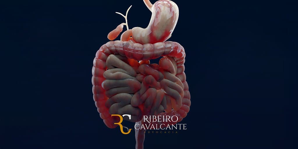 Doença de Crohn, auxílio-doença, aposentadoria por invalidez