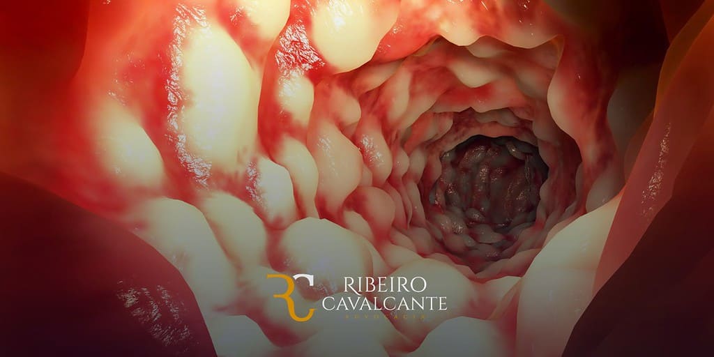 Doença de Crohn, auxílio-doença, aposentadoria por invalidez