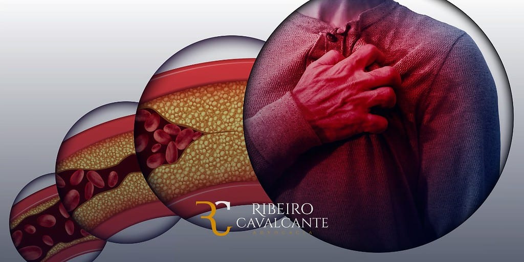 Cardiopatia grave: Auxílio-doença e aposentadoria por invalidez