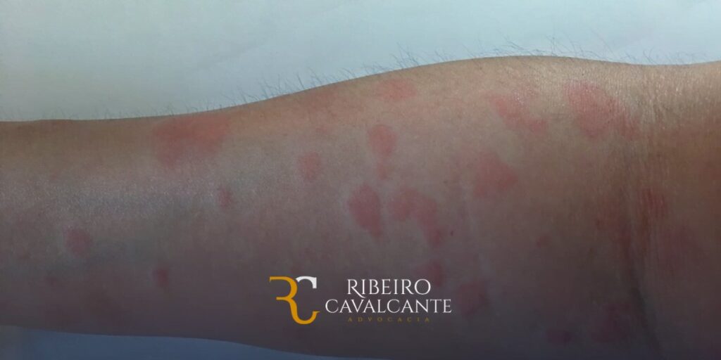 Braço com manchas vermelhas e irritação na pele. Logotipo Ribeiro Cavalcante Advocacia na parte inferior.