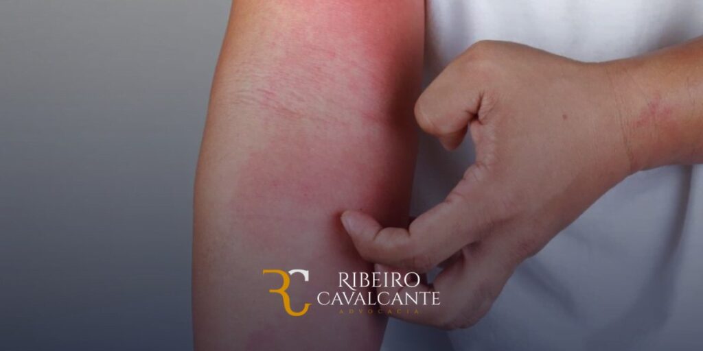 Pessoa arranhando braço avermelhado e irritado, possivelmente devido a dermatite. Logo do escritório Ribeiro Cavalcante advocacia.