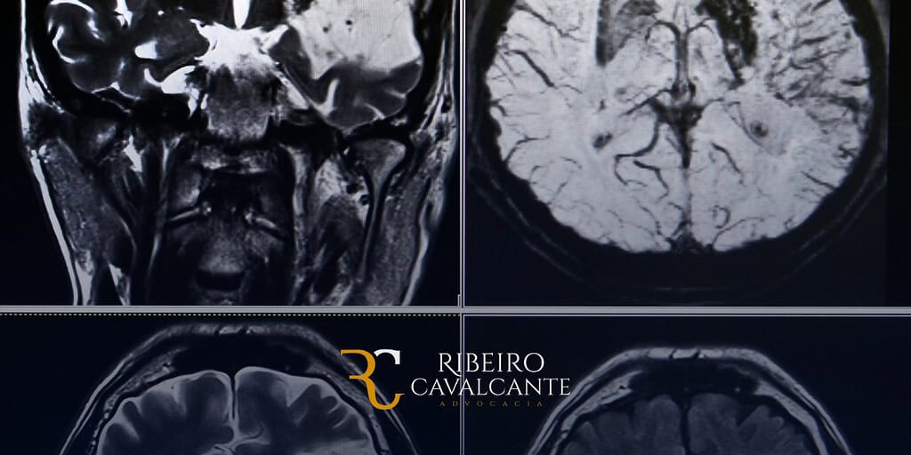 Exemplos de Incapacidades Causadas pelo AVC: