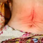 Cicatriz visível na pele da barriga.